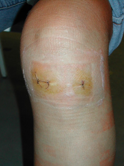 deformáló artrózis klinikai kezelés artrózis kezelése a jaltai